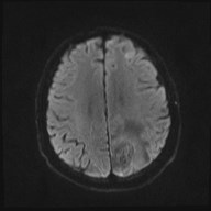 File:Cerebral toxoplasmosis (Radiopaedia 43956-47461 Axial DWI 15).jpg