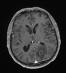 Cerebral toxoplasmosis (Radiopaedia 43956-47461 Axial T1 C+ 39).jpg
