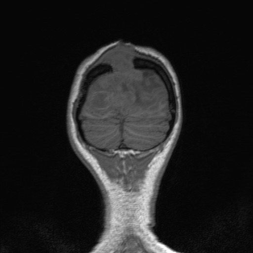 Cerebral tuberculosis with dural sinus invasion (Radiopaedia 60353-68090 Coronal T1 162).jpg