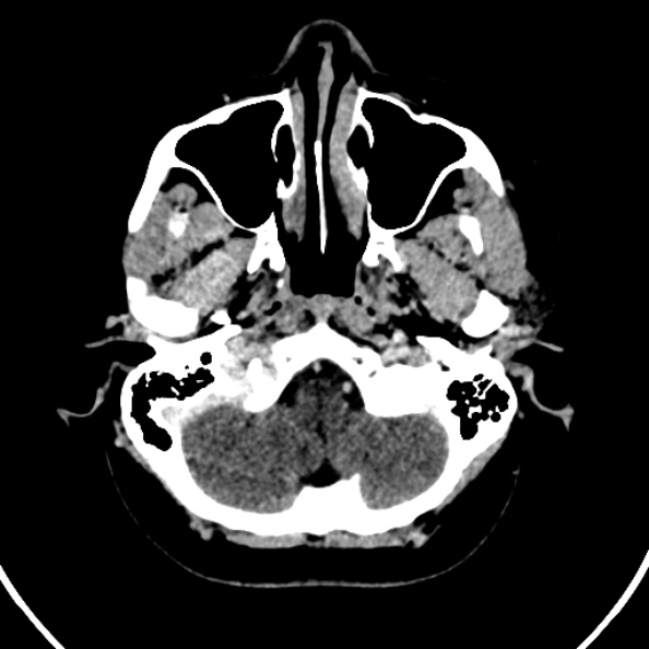 Cerebral venous hemorrhagic infarct from venous sinus thrombosis (Radiopaedia 55433-61883 Axial C+ delayed 130).jpg