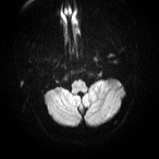 File:Cerebral venous infarction - hemorrhagic (Radiopaedia 81625-95505 Axial DWI 3).jpg
