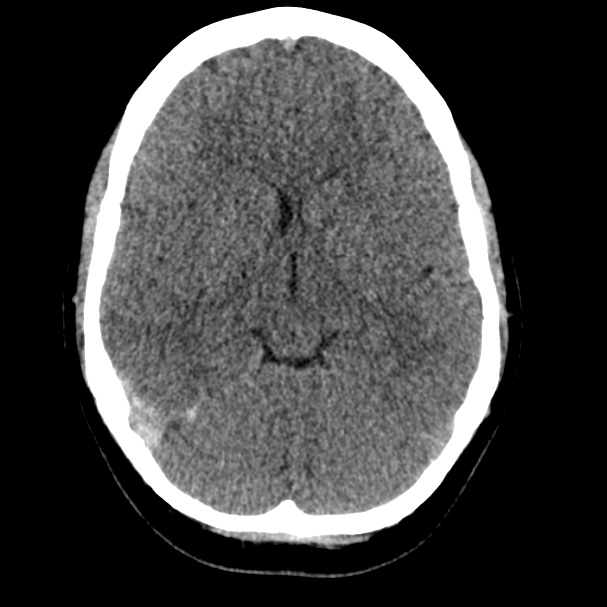 Cerebral venous sinus thrombosis (Radiopaedia 59224-66551 Axial non-contrast 5).jpg