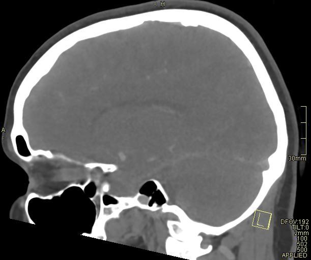 Cerebral venous sinus thrombosis (Radiopaedia 91329-108965 Sagittal venogram 31).jpg