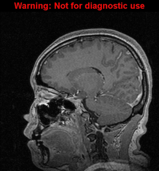 Cerebral venous thrombosis (Radiopaedia 37224-39208 Sagittal T1 C+ 90).jpg