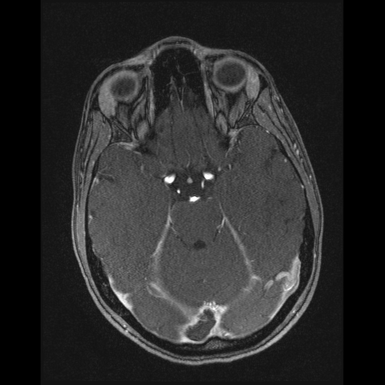 Cerebral venous thrombosis (Radiopaedia 45678-49854 Axial MRV 24).jpg
