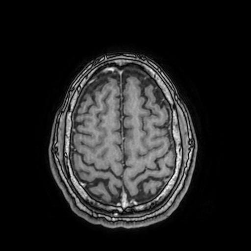 File:Cerebral venous thrombosis with secondary intracranial hypertension (Radiopaedia 89842-106957 Axial T1 C+ 138).jpg