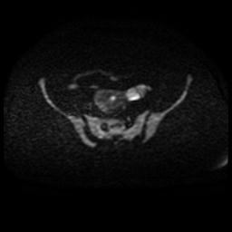 Cervical carcinoma (Radiopaedia 88010-104555 Axial DWI 58).jpg