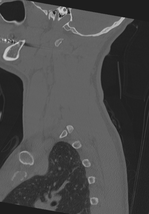 Cervical intercalary bone (Radiopaedia 35211-36748 Sagittal bone window 65).png