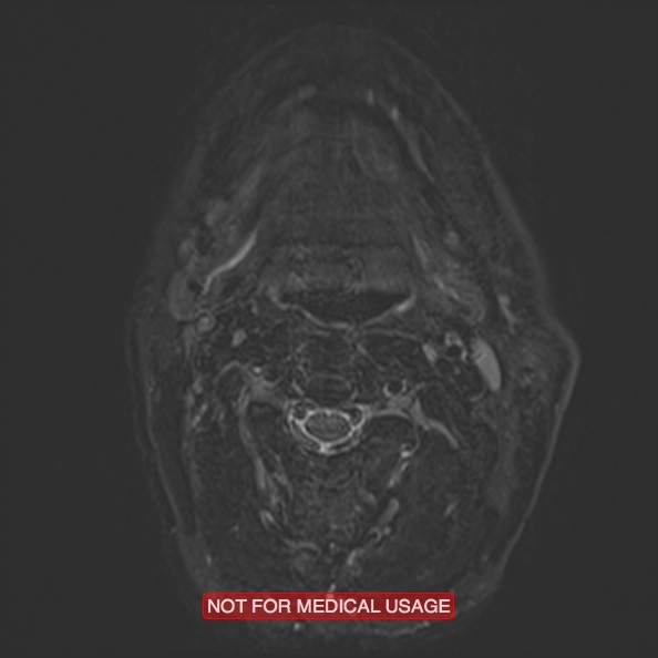 Cervical nerve schwannoma (Radiopaedia 27964-28221 C 27).jpg