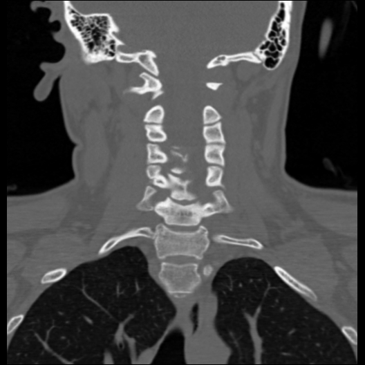 File:Cervical rib (Radiopaedia 71110-81363 Coronal non-contrast 24).jpg