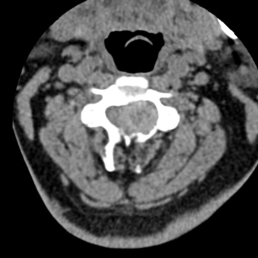 File:Cervical spinal neurofibroma in a patient with NF1 (Radiopaedia 58344-65464 Axial non-contrast 29).jpg