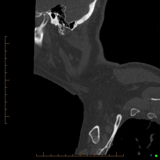 Cervical spine fracture - ankylosing spondylitis (Radiopaedia 76835-88706 Sagittal bone window 112).jpg
