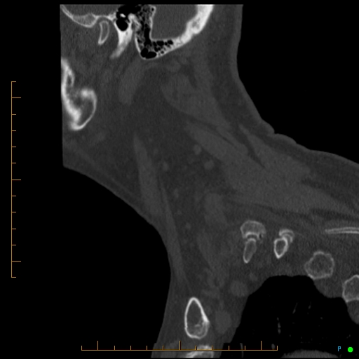 Cervical spine fracture - ankylosing spondylitis (Radiopaedia 76835-88706 Sagittal bone window 16).jpg