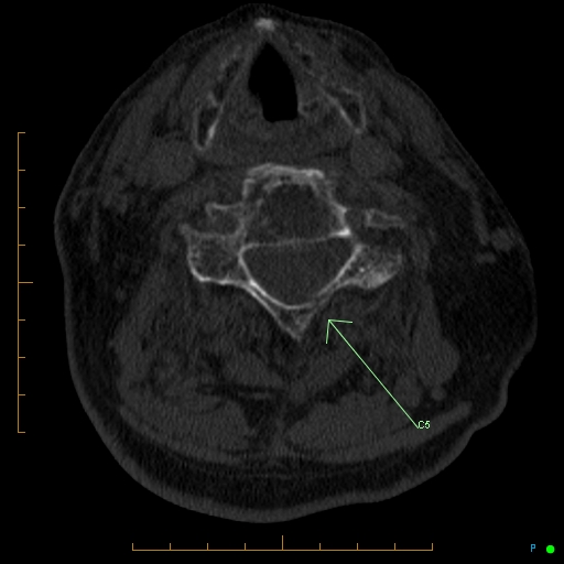 File:Cervical spine fracture - ankylosing spondylitis (Radiopaedia 76835-89037 KEY IMAGES ARROWS 4).jpg