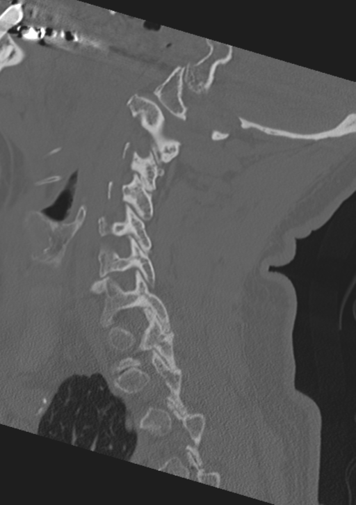 Cervical spine fractures with vertebral artery dissection (Radiopaedia 53296-59268 Sagittal bone window 45).png