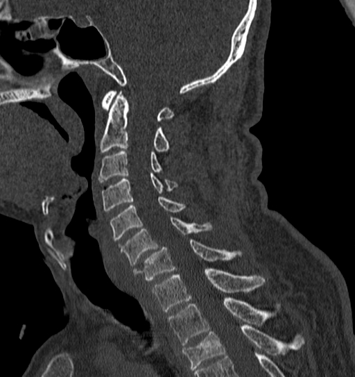 Cervical spine trauma with tear drop fracture and perched facet joint (Radiopaedia 53989-60127 Sagittal bone window 80).jpg