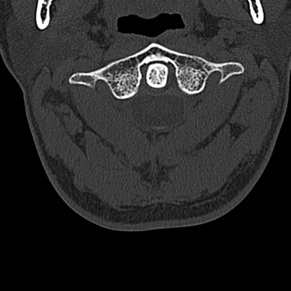 Cervical spondylodiscitis (Radiopaedia 28057-29489 Axial bone window 20).jpg