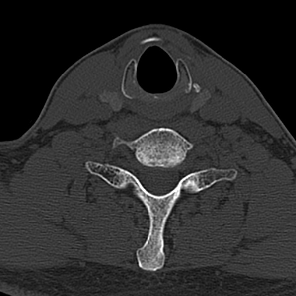Cervical spondylodiscitis (Radiopaedia 28057-29489 Axial bone window 57).jpg