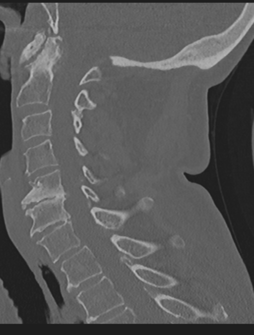 Cervical spondylolysis (Radiopaedia 49616-54811 Sagittal bone window 40).png