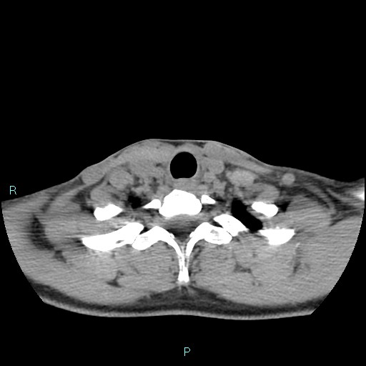 Cervical thymic cyst (Radiopaedia 88632-105335 Axial non-contrast 36).jpg