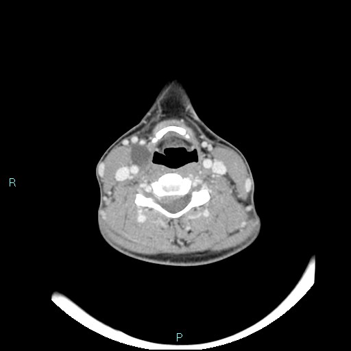 Cervical thymic cyst (Radiopaedia 88632-105335 C 58).jpg