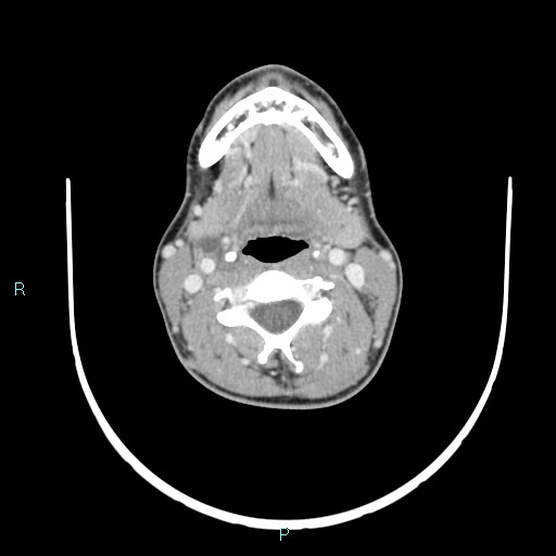 Cervical thymic cyst (Radiopaedia 88632-105335 C 69).jpg