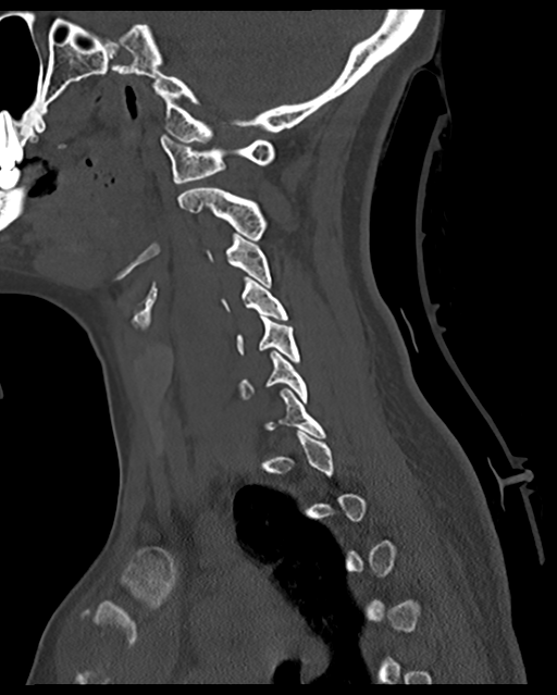Cervical tuberculous spondylitis (Radiopaedia 39149-41365 Sagittal bone window 46).png