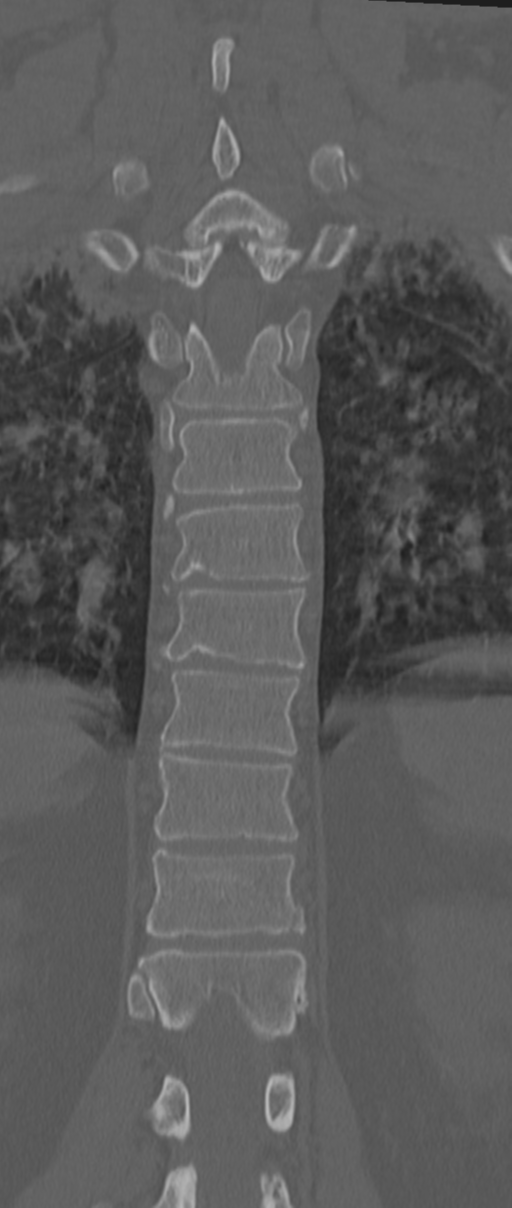 Chance fracture (Radiopaedia 33854-35020 Coronal bone window 55).png