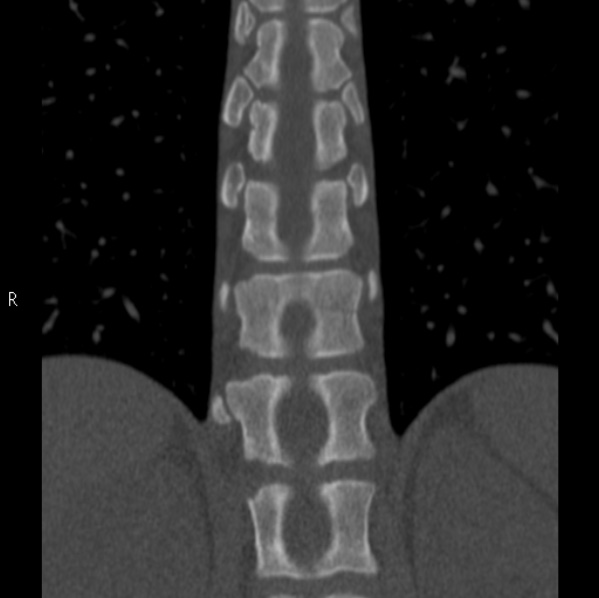 Chance fracture (Radiopaedia 36521-38081 Coronal bone window 31).jpg