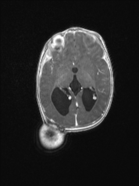 Chiari III malformation with occipital encephalocele (Radiopaedia 79446-92559 Axial T1 C+ mpr 50).jpg