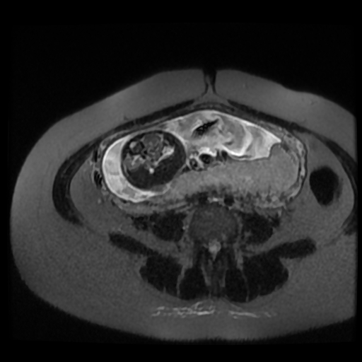 Chiari II malformation - fetal MRI (Radiopaedia 68099-77581 Axial T2-SSFSE 17).jpg
