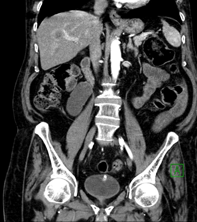 Cholangiocarcinoma with cerebral metastases (Radiopaedia 83519-98629 E 49).jpg