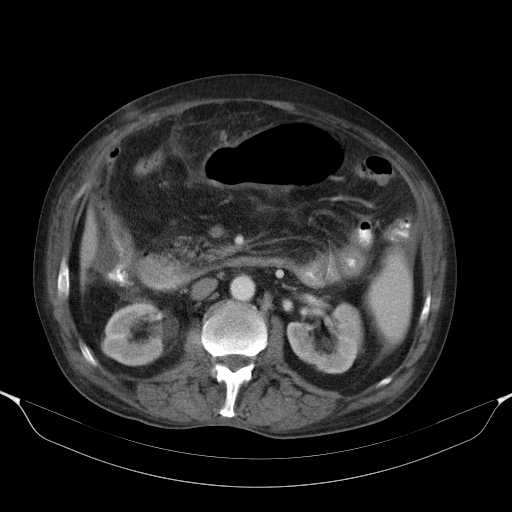 File:Cholangitis and abscess formation in a patient with cholangiocarcinoma (Radiopaedia 21194-21100 A 23).jpg