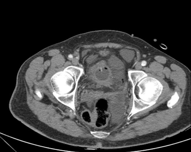 Cholecystitis - perforated gallbladder (Radiopaedia 57038-63916 A 77).jpg