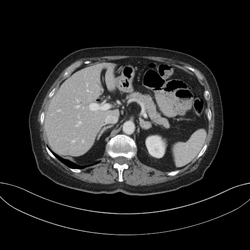 Cholecystoduodenal fistula due to calculous cholecystitis with gallstone migration (Radiopaedia 86875-103077 D 27).jpg