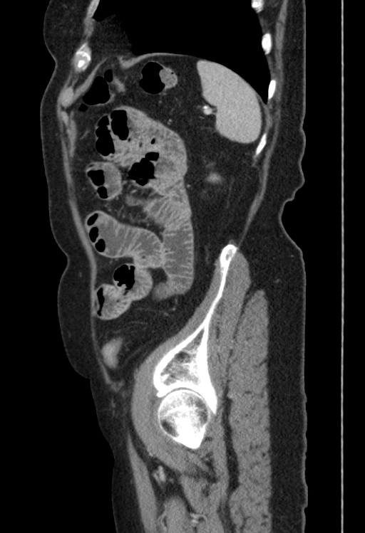 Cholecystoduodenal fistula due to calculous cholecystitis with gallstone migration (Radiopaedia 86875-103077 F 10).jpg