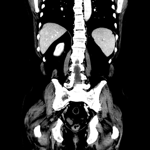 Choledocholiathiasis with normal caliber common bile duct (Radiopaedia 75368-86632 Coronal liver window 91).jpg