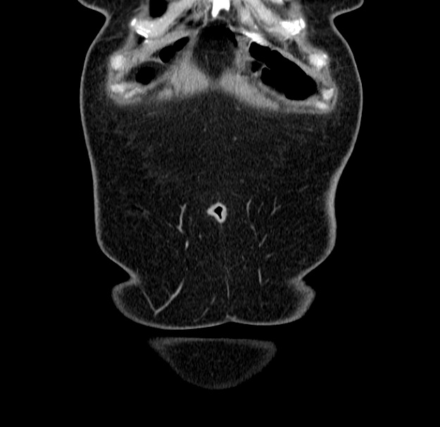 Choledocholithiasis on CT and MRI (Radiopaedia 24825-25087 C 4).jpg