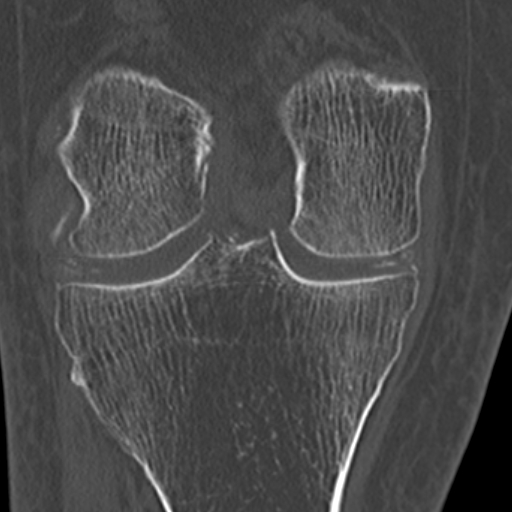Chondrocalcinosis (Radiopaedia 16275-15955 Coronal bone window 35).jpg