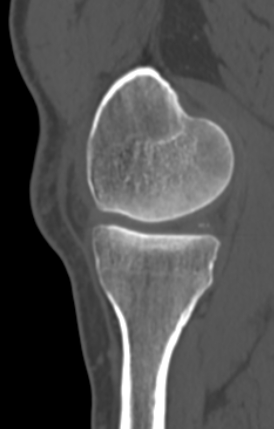 Chondrocalcinosis (Radiopaedia 82862-97173 Sagittal bone window 18).jpg