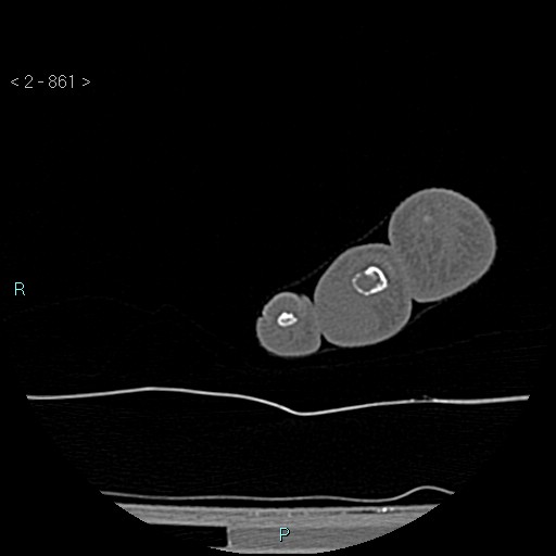 Chondrosarcoma - phalanx (Radiopaedia 69047-78812 Axial bone window 115).jpg