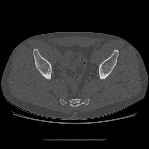 File:Chondrosarcoma of iliac wing (Radiopaedia 63861-72599 Axial bone window 83).jpg