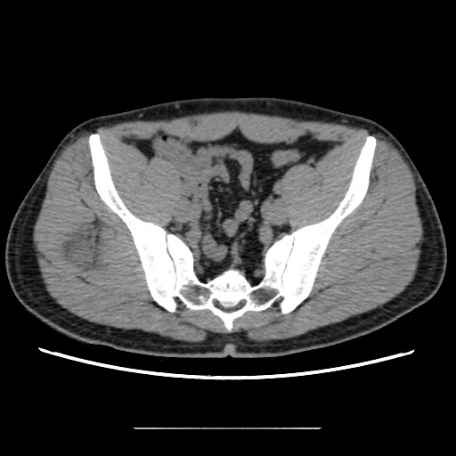 Chondrosarcoma of iliac wing (Radiopaedia 63861-72599 Axial non-contrast 67).jpg