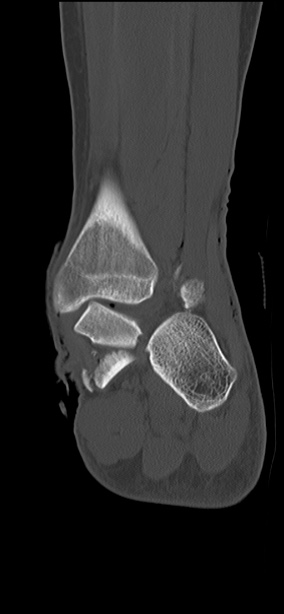 Chopart fracture (Radiopaedia 35347-36851 Coronal bone window 25).jpg
