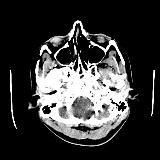 File:Choriocarcinoma of ovary with cerebral and pulmonary metastases (Radiopaedia 25983-26118 C+ arterial phase 9).jpg