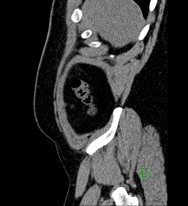 Chromophobe renal cell carcinoma (Radiopaedia 84286-99573 C 172).jpg