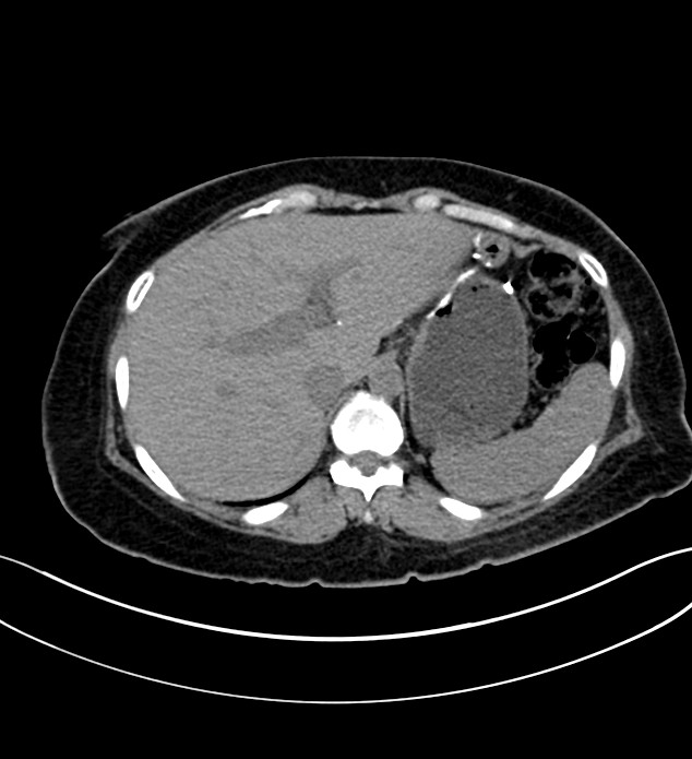 Chromophobe renal cell carcinoma (Radiopaedia 84290-99582 Axial non-contrast 31).jpg