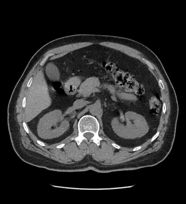 Chromophobe renal cell carcinoma (Radiopaedia 86879-103083 Axial non-contrast 29).jpg