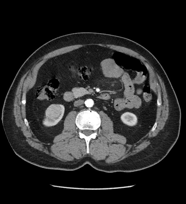 Chromophobe renal cell carcinoma (Radiopaedia 86879-103083 B 68).jpg