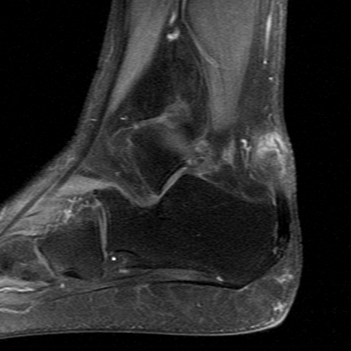 File:Chronic Achilles tendon rupture (Radiopaedia 15262-15100 C 4).jpg